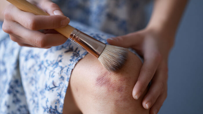 How to Cover a Bruise with Makeup Easily